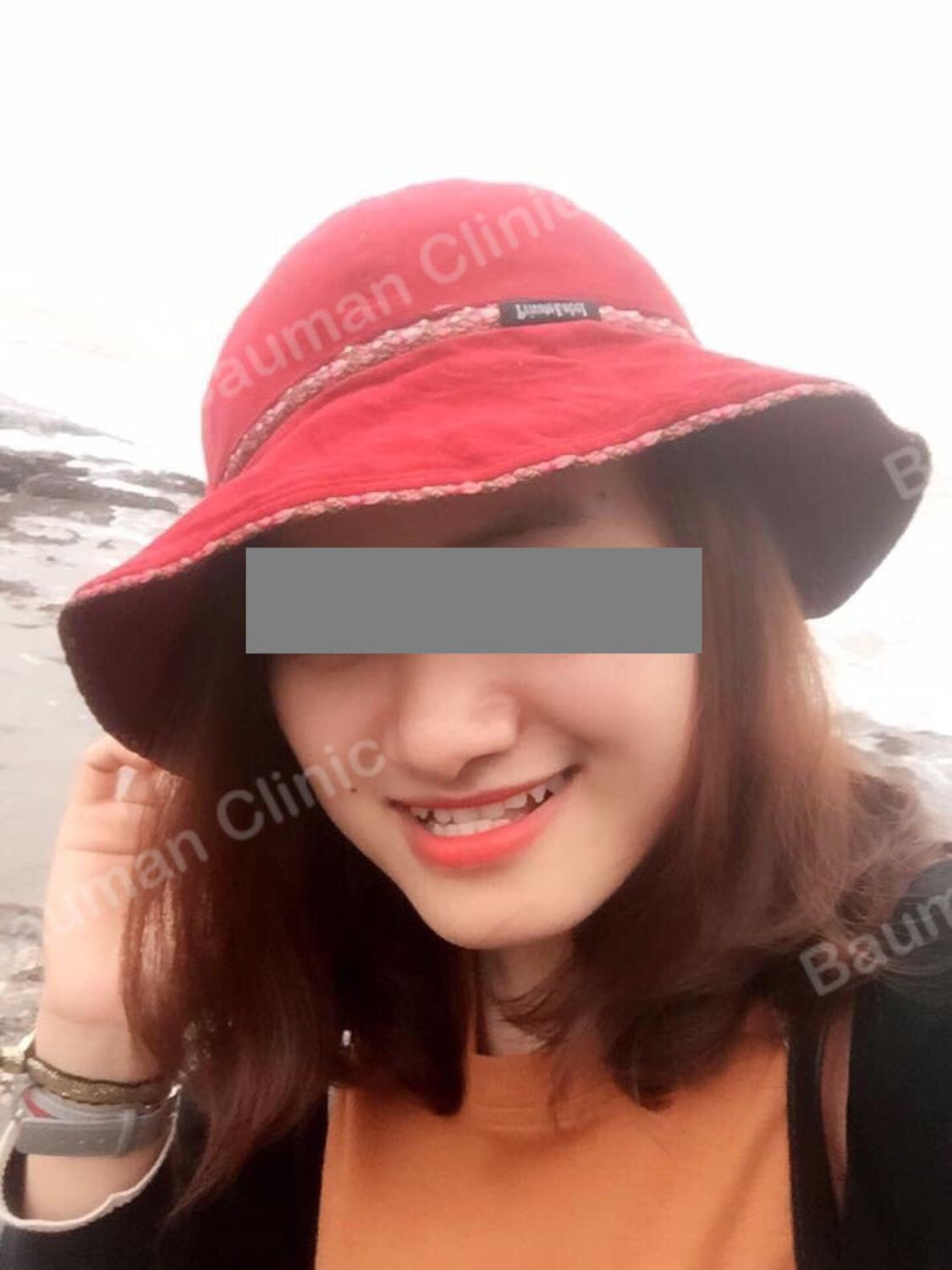 Ca niềng răng số 5027 - Nha khoa Bauman Clinic