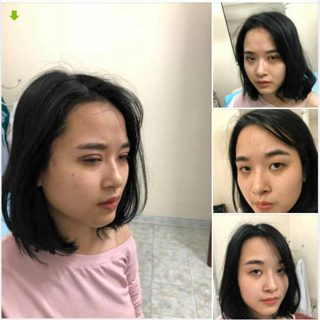 Hình ảnh bạn khách hàng ngay sau khi thực hiện cắt mí do bs Trung thực hiện!