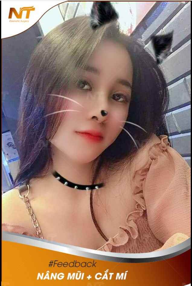Feedback khách hàng nâng mũi cắt mí siêu xinh chuẩn gái Hàn