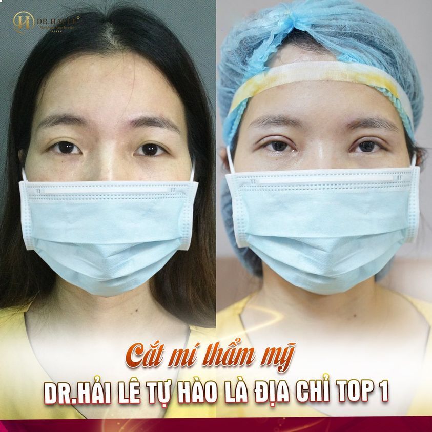 MUỐN CÓ MÍ ĐẸP CHUẨN XINH - LỰA CHỌN ĐÚNG ĐẮN NHẤT LÀ DR.HẢI LÊ.!