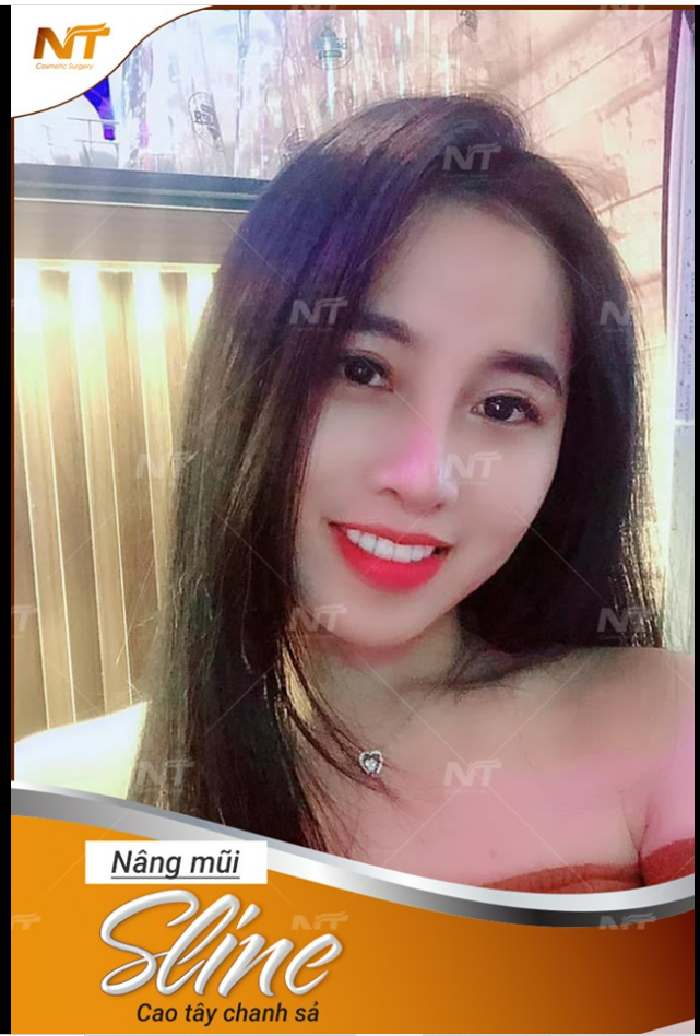 Feedback nâng mũi tại DR Ngọc Trung