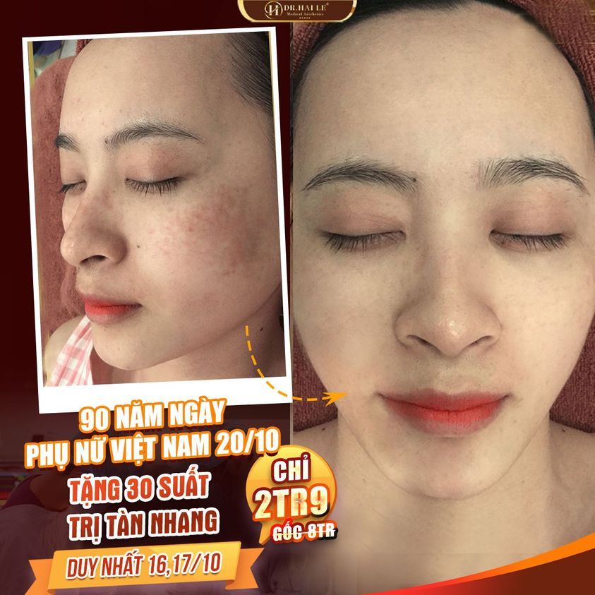 SIÊU HOT - Tặng 30 suất Trị tàn nhang chỉ 2tr9 (gốc 8 tr)