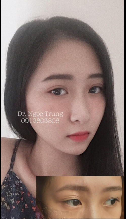 Phương pháp cắt mắt 2 mí Hàn Quốc