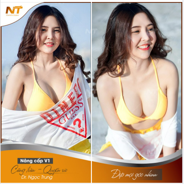 Ngư.c xinh hút mắt người nhìn - FEEDBACK nâng ngư.c tại DR Ngọc Trung