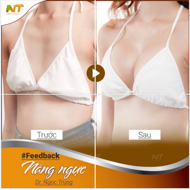 Feedback khách hàng nâng ngư.c tại DR Ngọc Trung