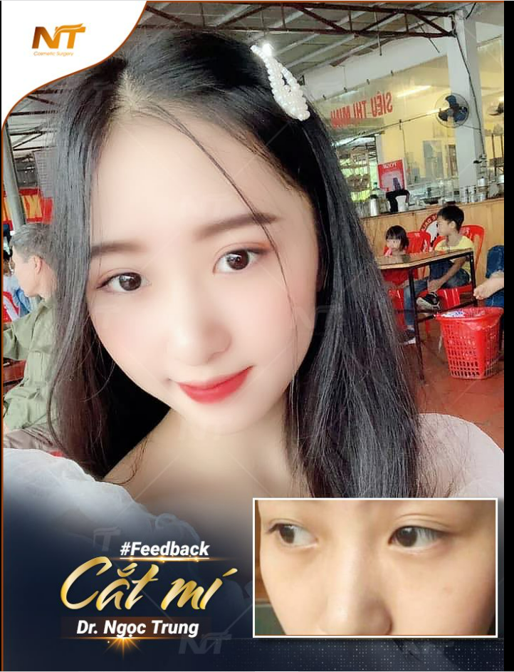 Kết quả cắt mí của khách sau 1 tuần tại nhà DR. Ngọc Trung như thế này là quá đẹp phải không ạ?