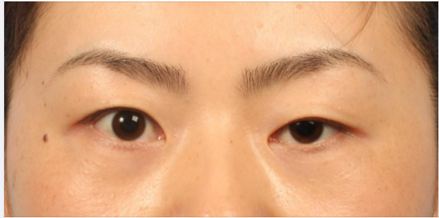 Sụp mi do nhược cơ có gì khác với sụp mi bẩm sinh ?