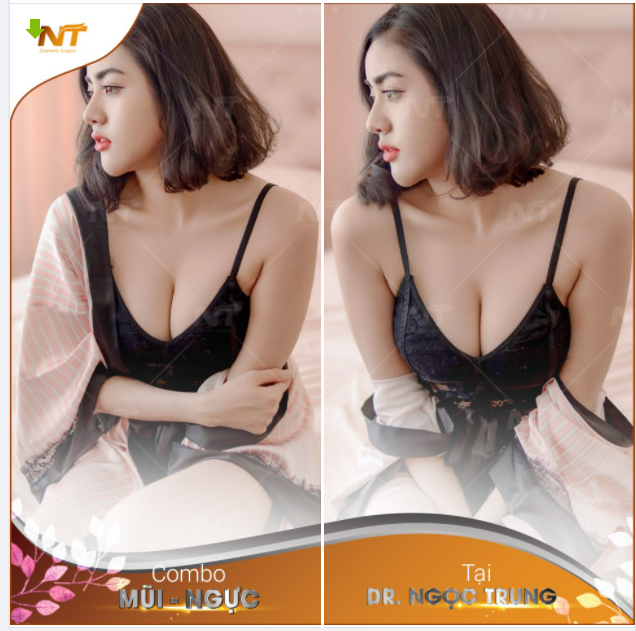 "Lúc đi chỉ định làm ngư.c thôi mà ai dè nhìn mũi của 1 khách nhà DR. Ngọc Trung đi tái khám mũi đẹp quá nên lại "quất luôn" quả combo mũi + ngư.c luôn ý"