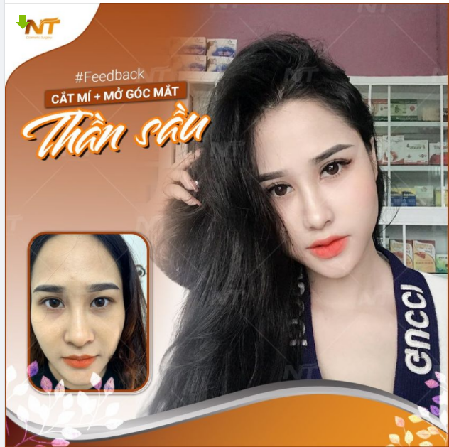 HÓA HOTGIRL CHỈ VỚI COMBO CẮT MÍ VÀ MỞ GÓC MẮT