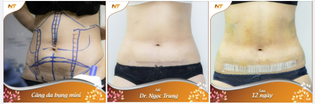 Trời ơi... Tin Được Không??? Trị TẬN GỐC - BỤNG MỠ sau sinh