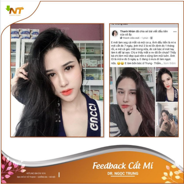 "Feedback "sương sương" đến từ khách yêu Đây là hình ảnh của bạn khách sau 1 tháng cắt mí