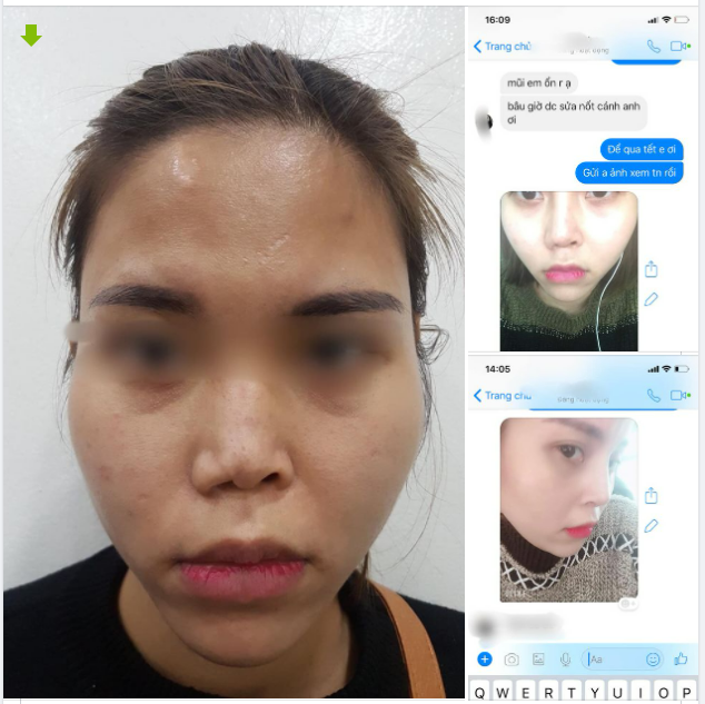 Đây là hình ảnh ca mũi đã làm tại một cơ sở không phải bác sĩ thực hiện, còn một lần mổ nữa mới đẹp được.