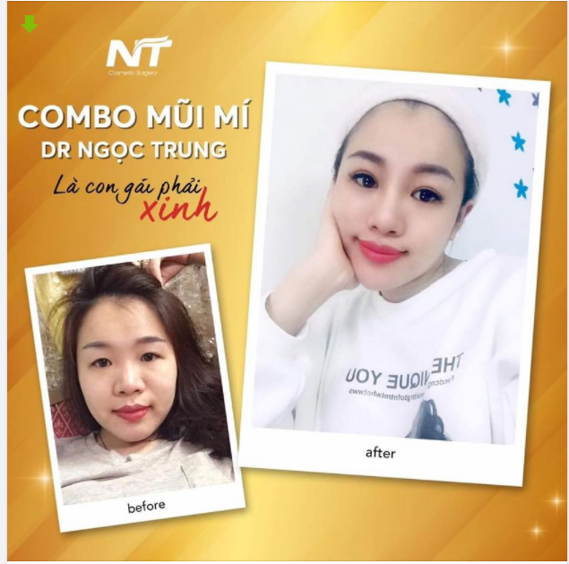 THẬT SỰ BẤT NGỜ VỚI KẾT QUẢ ĐẸP KHÔNG TÌ VẾT CỦA CHỊ KHÁCH COMBO MŨI + MÍ TẠI DR NGỌC TRUNG