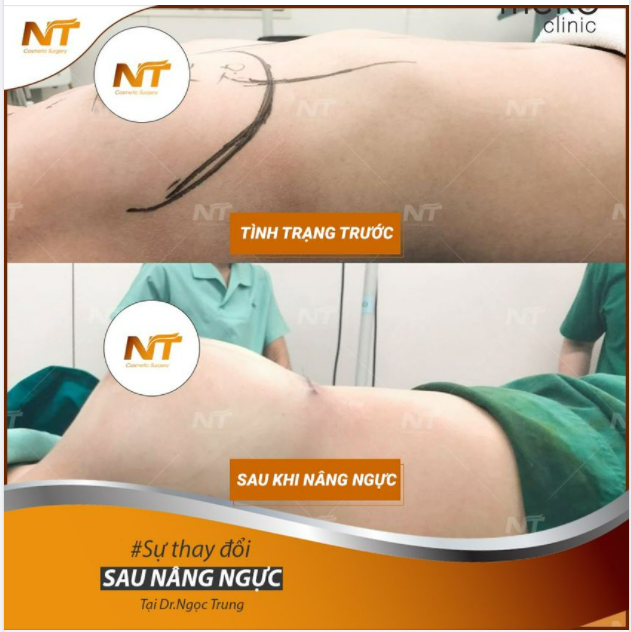 NÂNG NGỰC SƯƠNG SƯƠNG, LÀM ANH VẤN VƯƠNG