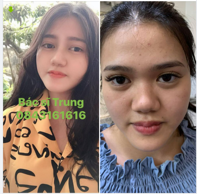 NHỮNG TIÊU CHẨN CỦA MỘT CHIẾC MŨI ĐẸP
