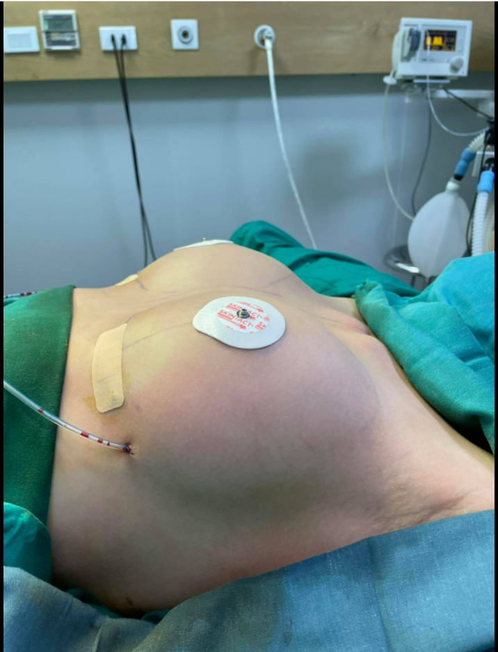 Kích cỡ túi ngực Kích cỡ thực tế của một túi độn ngực được đo bằng cc.