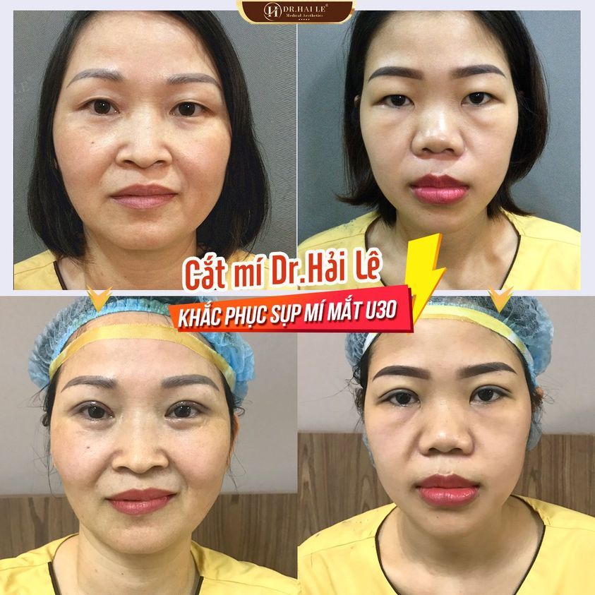 30 PHÚT CẮT MÍ THẨM MỸ  Khắc phục tình trạng sụp mí mắt tuổi 30+