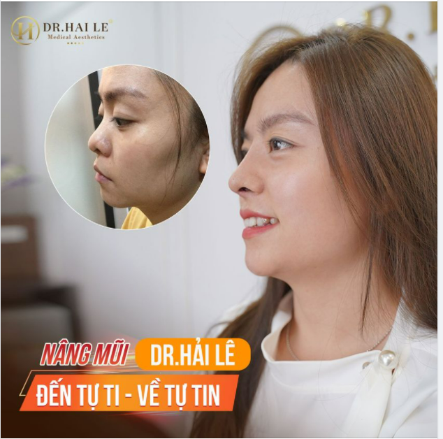 Mãn nhãn với DEMI 5D - 10 ngày tại Dr.Hải Lê!