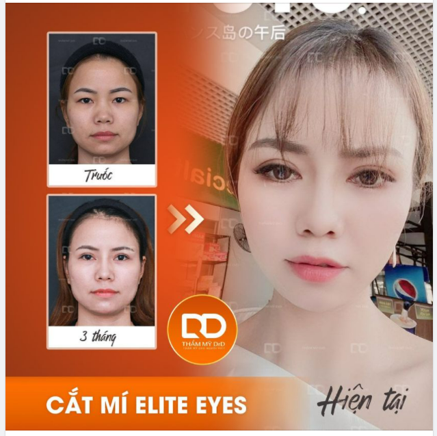 Ai rồi cũng thay đổi, chỉ có Cắt mí Elite Eyes là "không đổi"