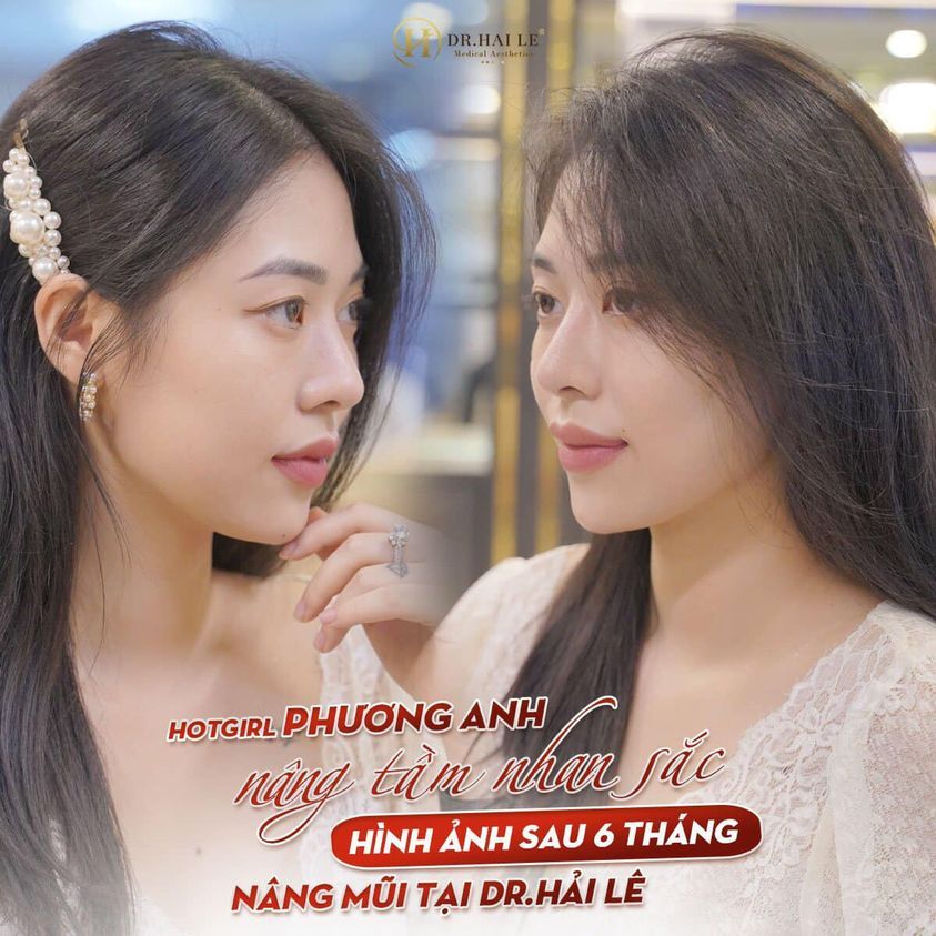 BẠN CHỌN "MŨI ĐẸP SANG" NHƯ HOTGIRL PHƯƠNG ANH HAY CHẤP NHẬN “XẤU BỀN" MÃI MÃI