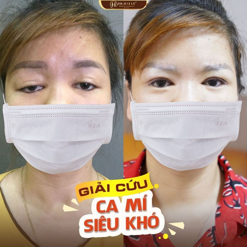 BẠN ĐƯỢC GÌ KHI SỬA MÍ TẠI DR.HẢI LÊ ?