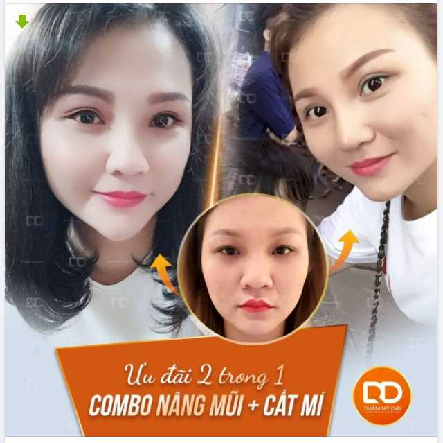 Bật mí bí mật trong Combo Nâng mũi + Cắt mí