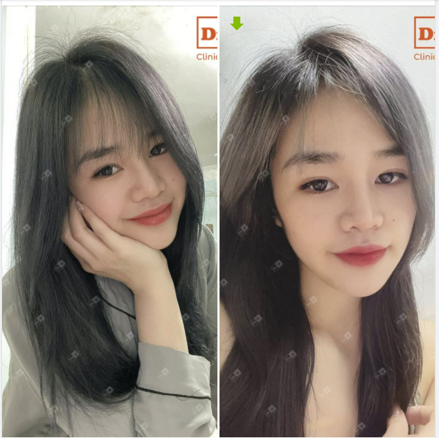 Bên cạnh mái tóc thì dáng mũi cũng là tiêu chuẩn tạo nên sức hút ngoại hình cho các nàng đấy ạ.