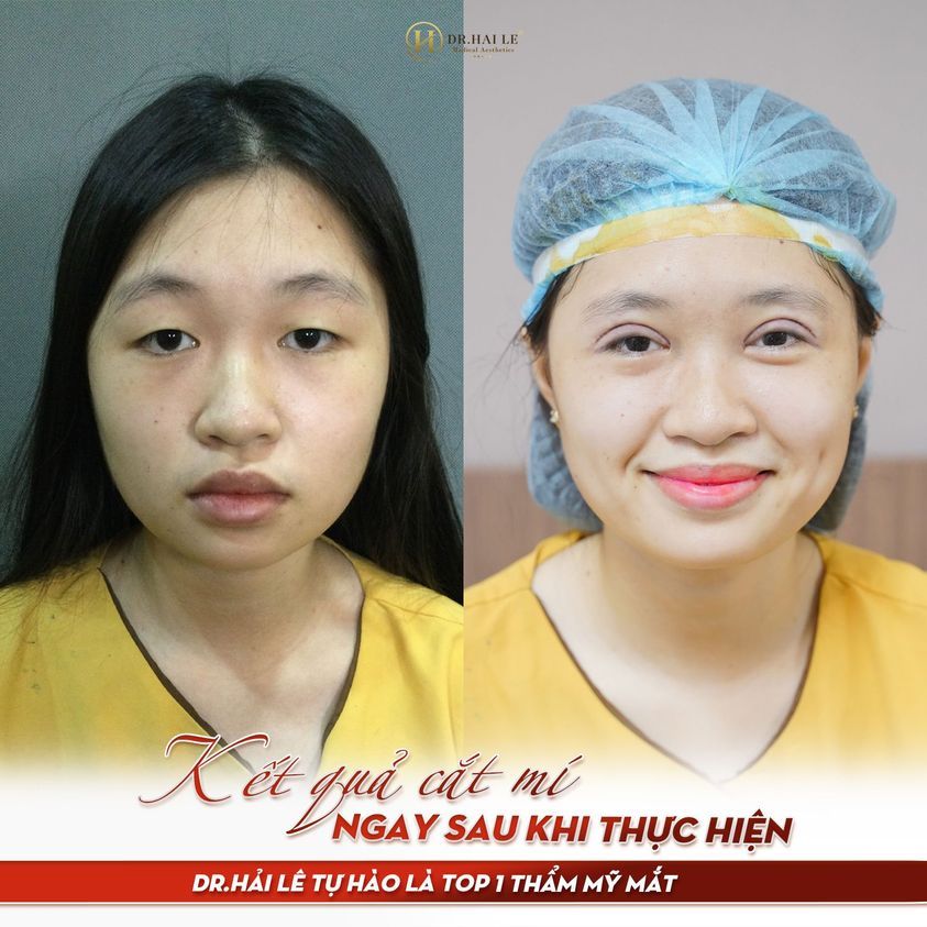 BÍ QUYẾT CHĂM SÓC SAU CẮT MÍ GIÚP MẮT MAU HẾT SƯNG.!