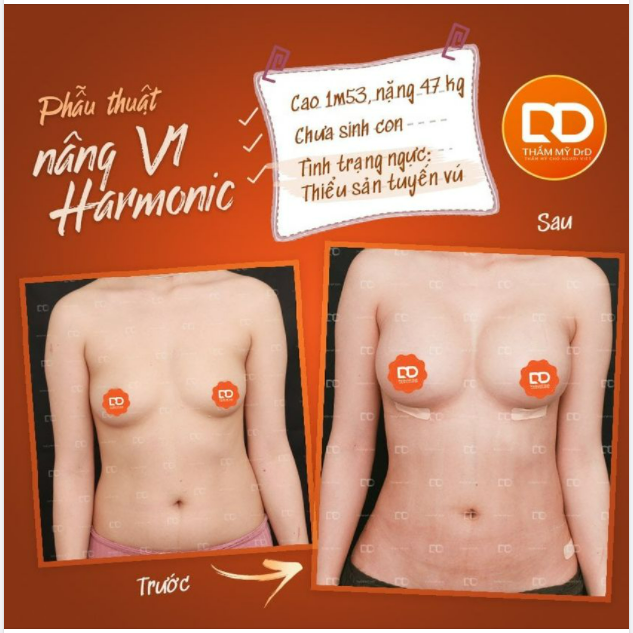 Bơm ngực và Nâng ngực khác nhau như thế nào?