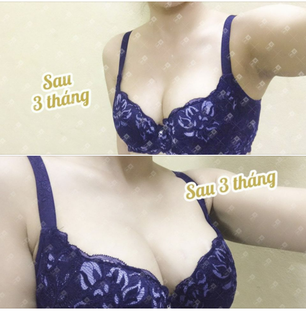 Các nàng có tin đây là kết quả treo ngực sa trễ độ 4 không đặt túi sau 3 tháng không ạ? Khách hàng nói rằng "mặc áo lên xong như ngực nâng thường luôn".