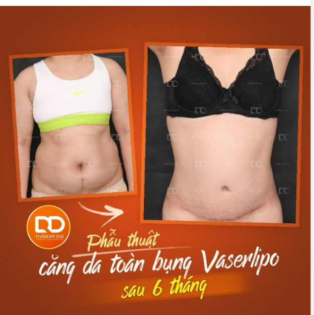 Các nàng hay lo lắng về vấn đề sẹo sau phẫu thuật Căng da tạo hình thành bụng thì tham khảo ngay hình ảnh dưới đây nhé.