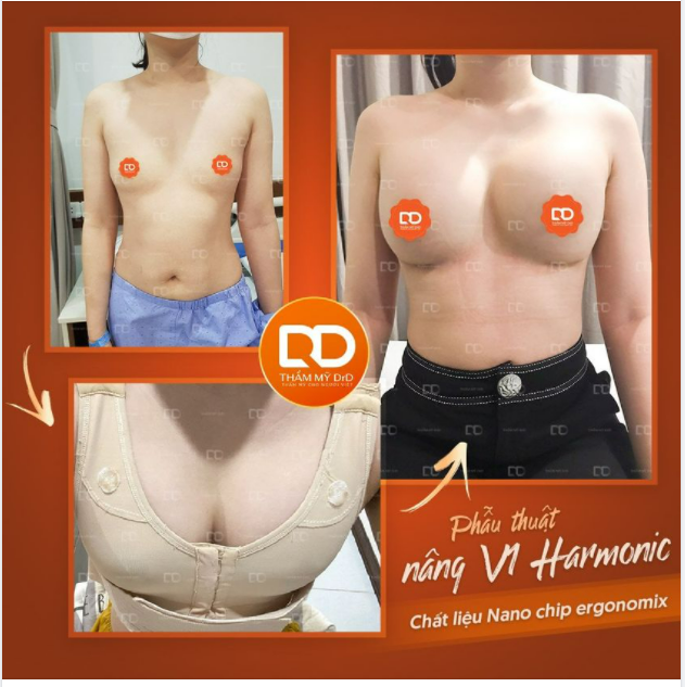 Các nàng ơi, thỉnh thoảng cùng DrD "đổi gió" "mổ xẻ" và phân tích một chút về tình trạng ngực của khác hàng các nàng nhé!