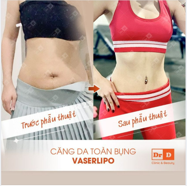 Căng da tạo hình toàn bụng Vaserlipo hiệu quả chỉ trong 1 lần thực hiện. Nhưng để duy trì được kết quả lâu dài, hãy lưu ý những bí quyết sau