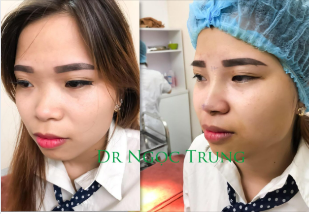 Nâng mũi cấu trúc L line