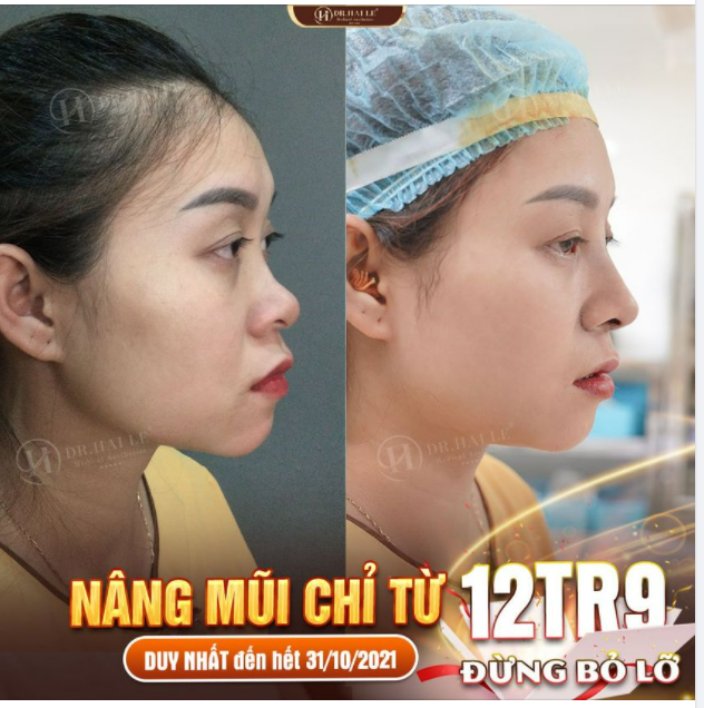 Nâng mũi cao sang Rinh ngàn quà tặng tại Dr.Hải Lê