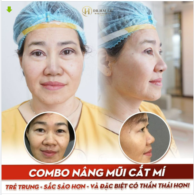 COMBO NÂNG MŨI CẮT MÍ ĐỈNH CAO