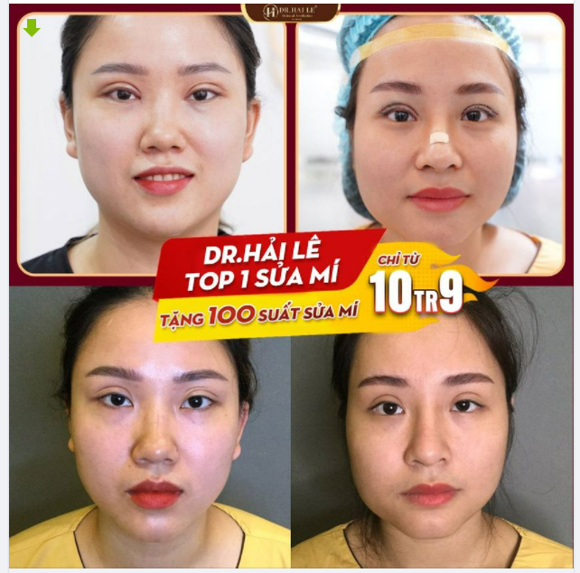 SỬA MÍ DEEP TECH GÂY BẤT NGỜ VỚI KẾT QUẢ TRƯỚC SAU!