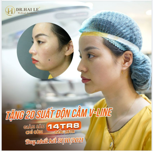 ĐỘN CẰM V-LINE TẠI DR.HẢI LÊ CÓ GÌ ĐẶC BIỆT?