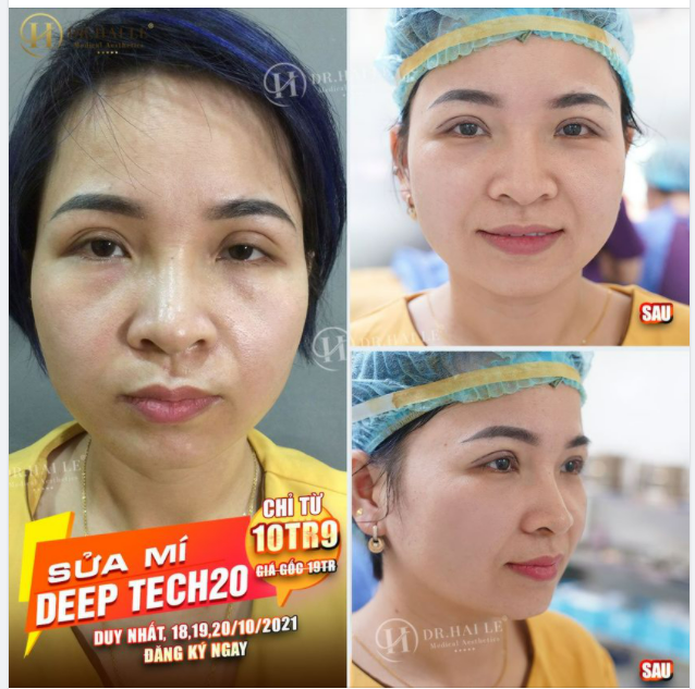 SỬA MÍ DEEP TECH20 - DR.HẢI LÊ CAM KẾT LUÔN LÀM KHÁCH HÀNG HÀI LÒNG.!!
