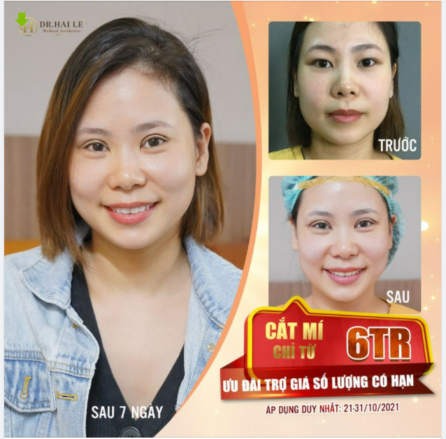 CHỚP CƠ HỘI CẮT MÍ VỚI GIÁ SIÊU HỜI TẠI DR.HẢI LÊ