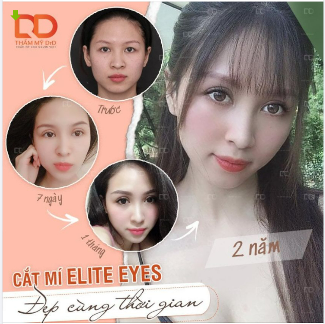 Cắt mí đẹp được đến bao nhiêu năm?