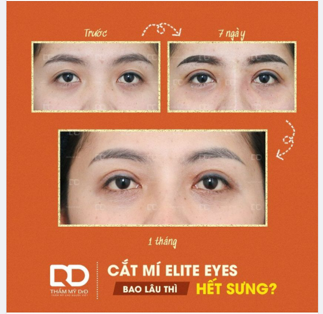 Cắt mí Elite Eyes bao lâu thì hết sưng?