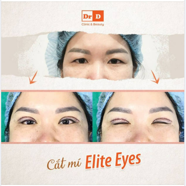 Cắt mí Elite Eyes có đúng như lời đồn?