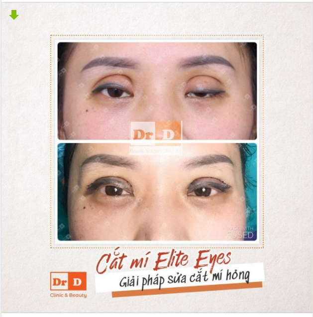 Cắt mí hỏng nếu không được xử lý kịp thời sẽ để xảy ra nhiều ảnh hưởng đến sức khỏe và thẩm mỹ. Vậy đâu là nguyên nhân?