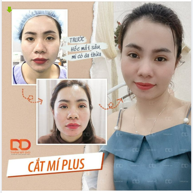 Cắt mí Plus: Cải thiện khuyết điểm từ A đến Z