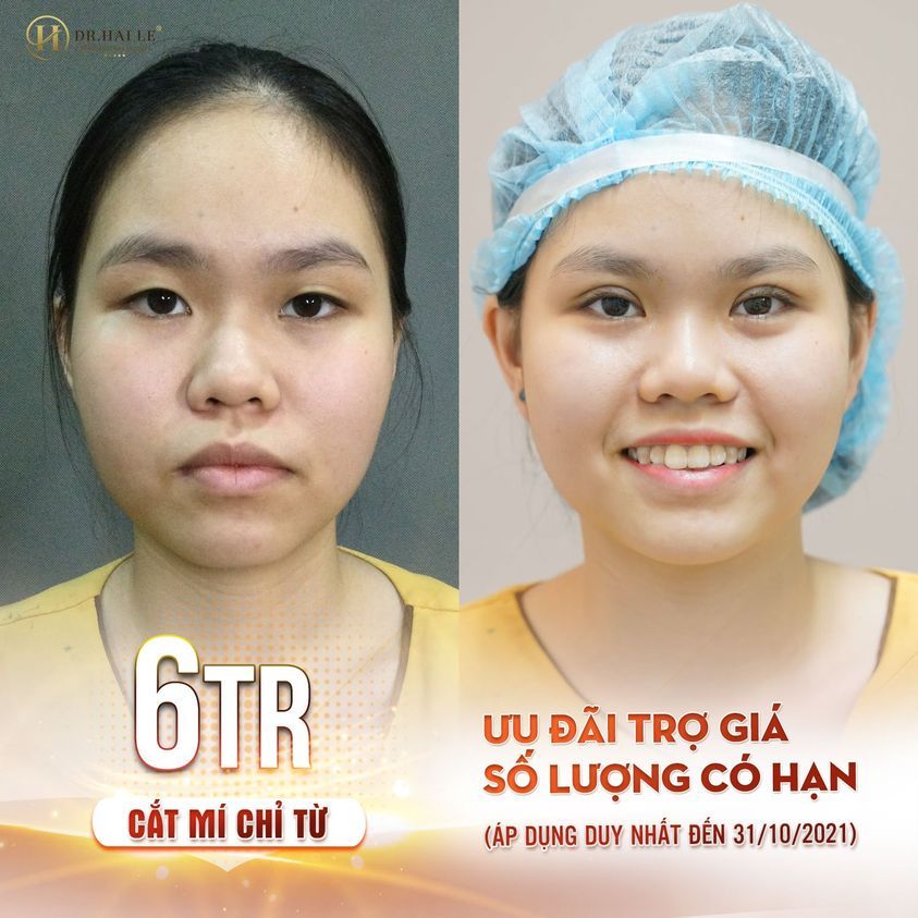 CẮT MÍ THẨM MỸ - MỘT TIỂU PHẪU NHỎ, MỘT THAY ĐỔI LỚN