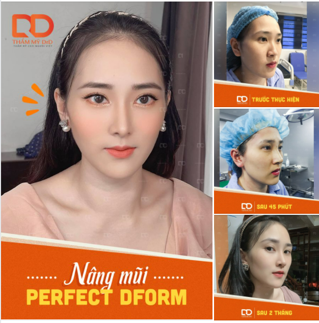 Câu hỏi không thể thiếu trong mỗi lần tư vấn: "Bạn mong muốn nâng mũi tự nhiên hay cao tây?"