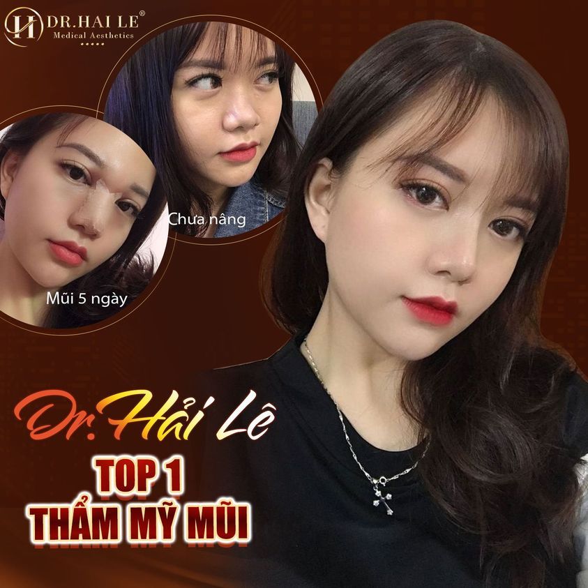 Chăm sóc sau nâng mũi cũng là bước quan trọng ảnh hưởng đến kết quả thẩm mỹ.