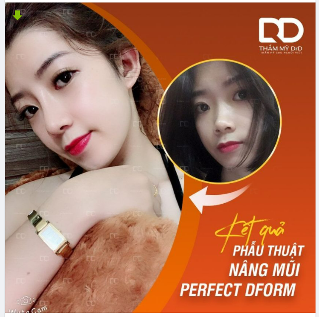 CHỈ CẦN INBOX - TẶNG NGAY 5 TRIỆU CHO DÁNG MŨI PERFECT DFORM