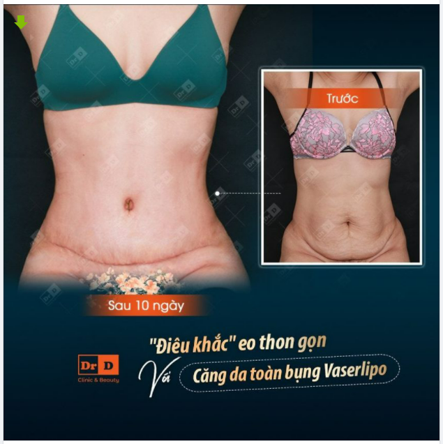 Chỉ thực hiện hút mỡ đơn thuần có loại bỏ được da thừa, da chùng không? ​​​​​​​Chắc chắn là không.
